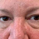 Eyelid Lift Before & After Patient #1784
