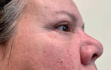 Eyelid Lift Before & After Patient #1784