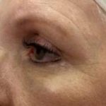 Eyelid Lift Before & After Patient #3018