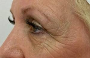 Eyelid Lift Before & After Patient #3018