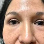 Eyelid Lift Before & After Patient #3023