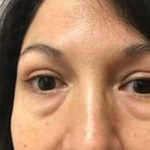 Eyelid Lift Before & After Patient #3023