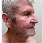 Facelift Before & After Patient #1895