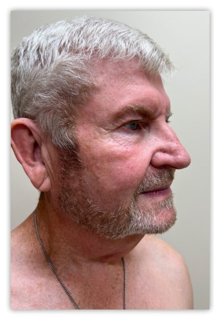 Facelift Before & After Patient #1895