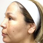 Facial Fat Transfer Before & After Patient #3033