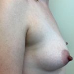 Fat Transfer To Breast Before & After Patient #2342