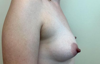 Fat Transfer To Breast Before & After Patient #2342