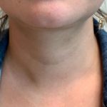 Neck Liposuction Before & After Patient #2058