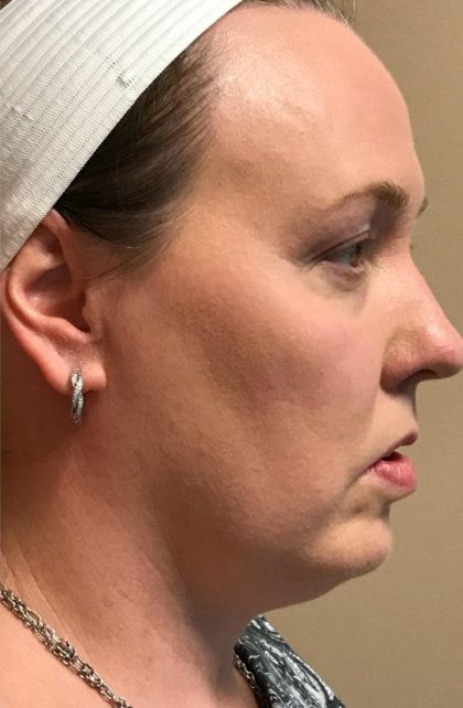 Neck Liposuction Before & After Patient #2144