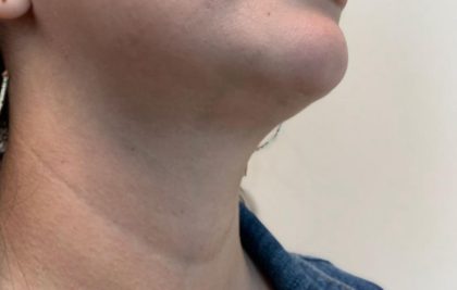 Neck Liposuction Before & After Patient #2058