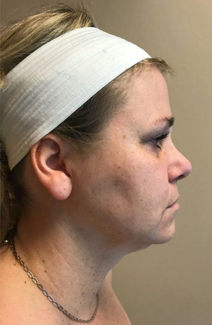Neck Liposuction Before & After Patient #2143