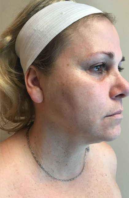 Neck Liposuction Before & After Patient #2143