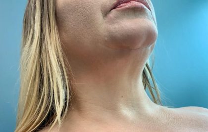 Neck Liposuction Before & After Patient #2062