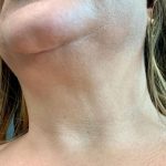 Neck Liposuction Before & After Patient #2062