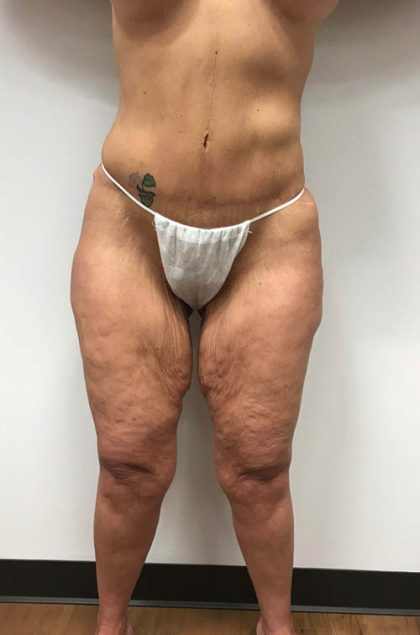 Lower Body Lift Before & After Patient #1145