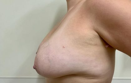 Breast Lift With Implant Exchange Before & After Patient #2503