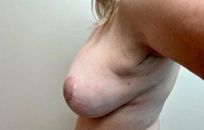 Breast Lift With Implant Exchange Before & After Patient #2504