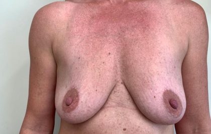 Breast Lift With Augmentation Before & After Patient #2682