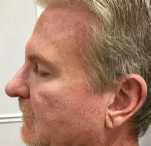 Men’s Injectables Before & After Patient #1810