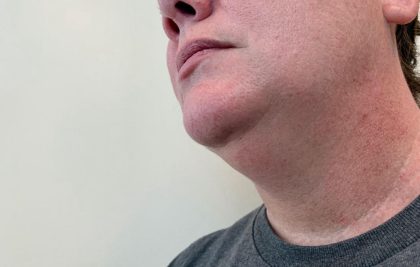 Neck Liposuction Before & After Patient #2063