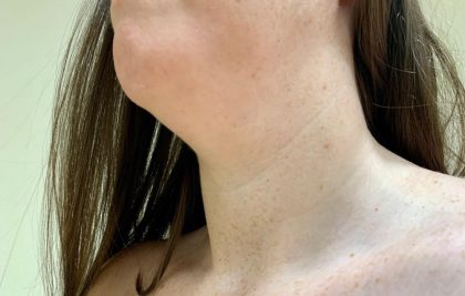 Neck Liposuction Before & After Patient #2064