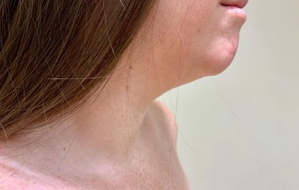 Neck Liposuction Before & After Patient #2064