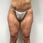 Thigh Lift Before & After Patient #2894