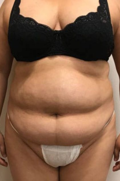 Tummy Tuck Before & After Patient #3113