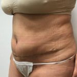 Tummy Tuck Before & After Patient #3113