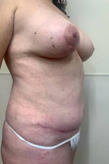 Tummy Tuck Before & After Patient #3152