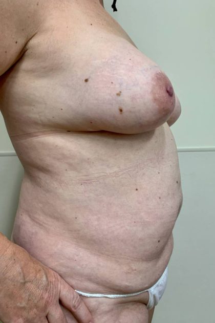 Tummy Tuck Before & After Patient #3152