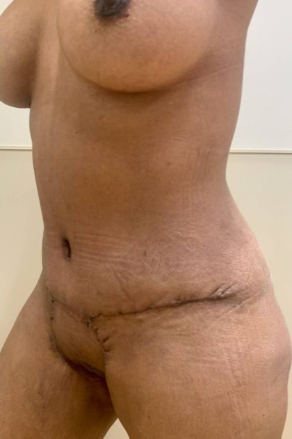Tummy Tuck Before & After Patient #3192