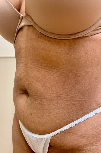 Tummy Tuck Before & After Patient #3192