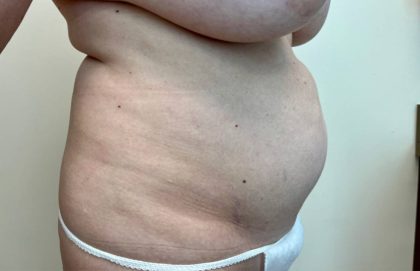 Tummy Tuck Before & After Patient #3190