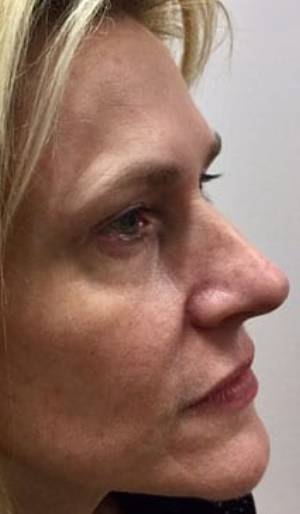 Women's Injectables Before & After Patient #2077