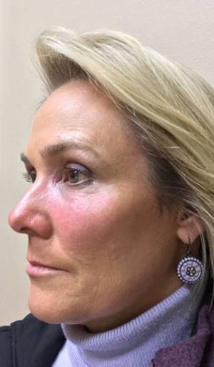 Women's Injectables Before & After Patient #2078