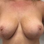 Breast Lift With Augmentation Before & After Patient #2688