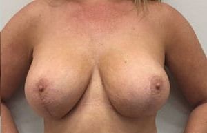 Breast Lift With Augmentation Before & After Patient #2688