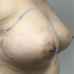 Fat Transfer To Breast Before & After Patient #2343