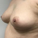 Fat Transfer To Breast Before & After Patient #2343