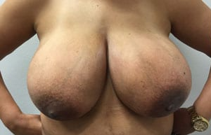 Breast Reduction Before & After Patient #2398