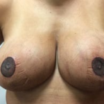 Breast Reduction Before & After Patient #2398