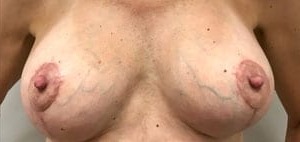 Breast Lift Before & After Patient #2594