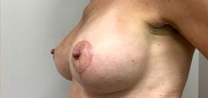 Breast Lift Before & After Patient #2594