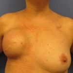 Breast Reconstruction Before & After Patient #2454