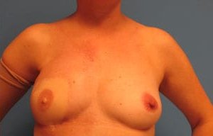 Breast Reconstruction Before & After Patient #2454