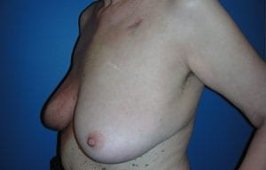 Breast Reconstruction Before & After Patient #2460