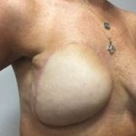 Breast Reconstruction Before & After Patient #2461