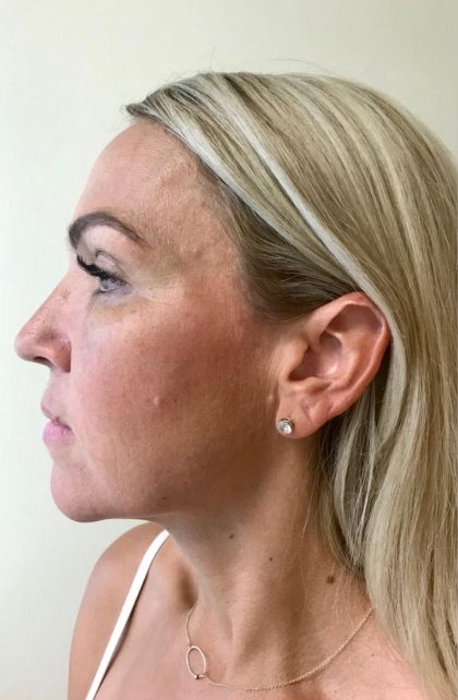 Neck Liposuction Before & After Patient #2140