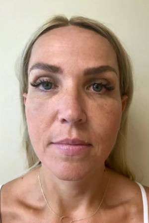 Women's Injectables Before & After Patient #2080